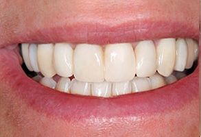 Smiles for Life | Teeth Whitening, Implant Restorations and Oral Exams